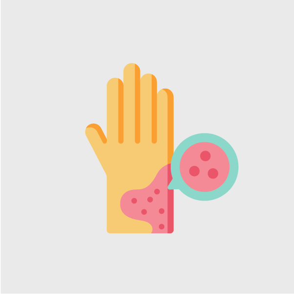 Reacción alérgica en mano